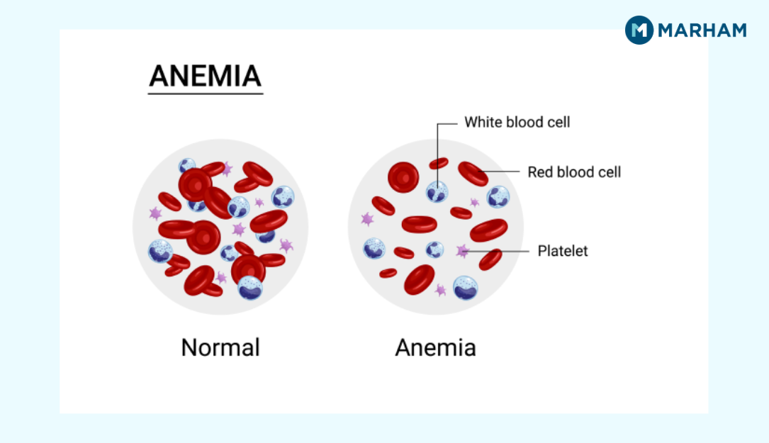 MCH Blood Test Low Symptoms