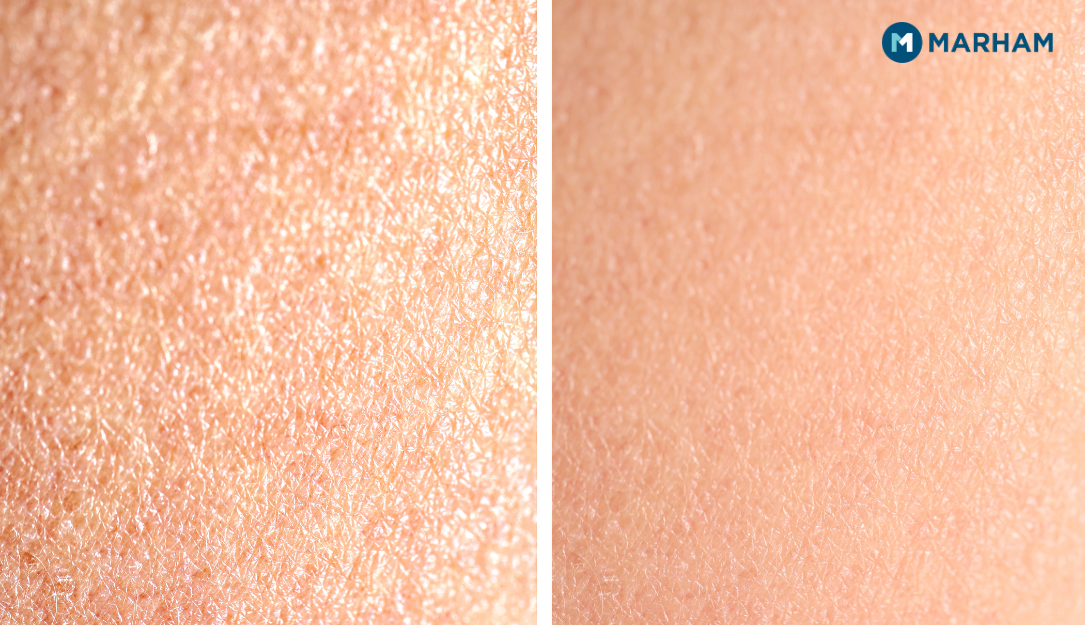 Microneedling aftercare