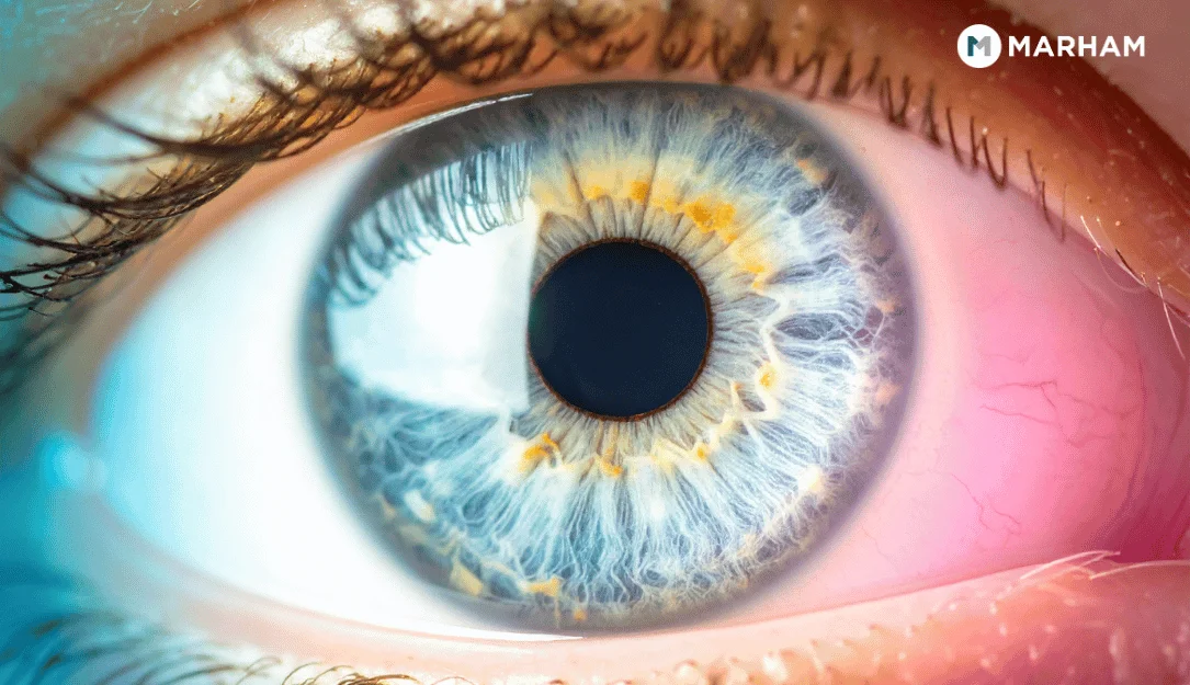 Cornea Transplant in Pakistan