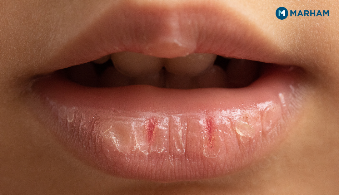 رمضان میں پانی کی کمی کی عام علامات