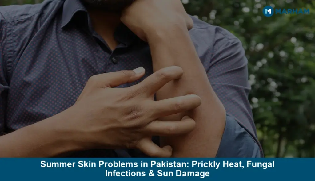 Summer Skin Problems in Pakistan: Prickly Heat, Fungal Infections & Sun Damage Summer Skin Problems in Pakistan: Prickly Heat, Fungal Infections & Sun Damage
