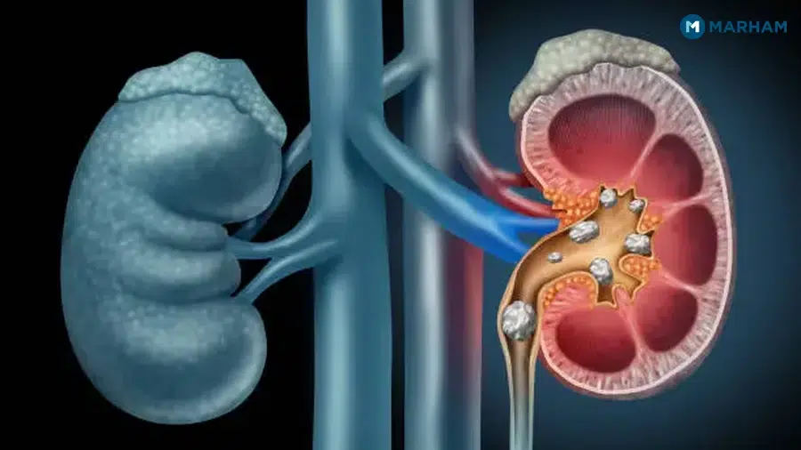 Causes and Risk Factors for Kidney Stones in Pakistan