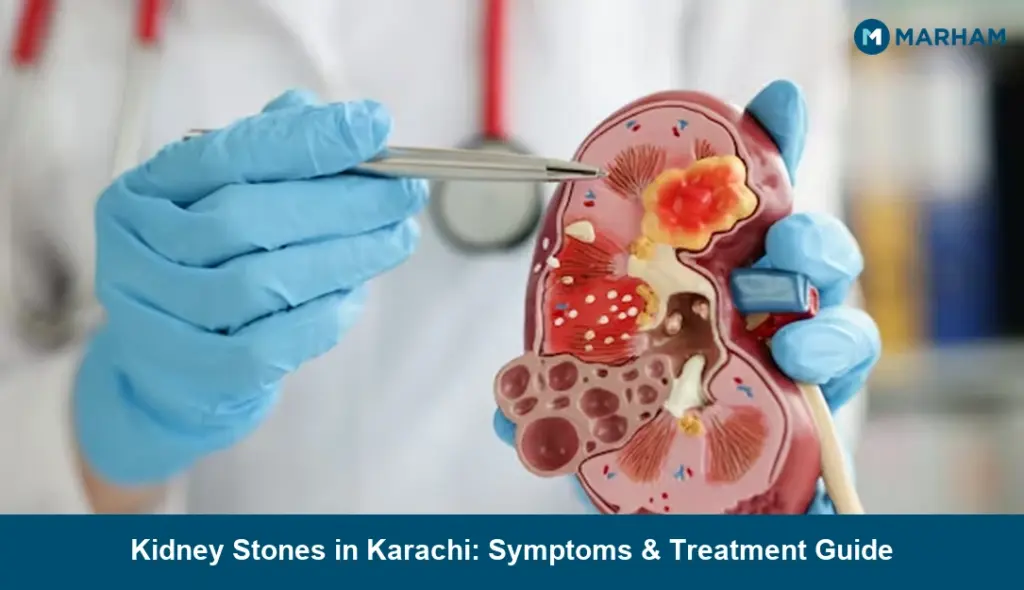 Kidney Stones in Karachi: Symptoms & Treatment Guide