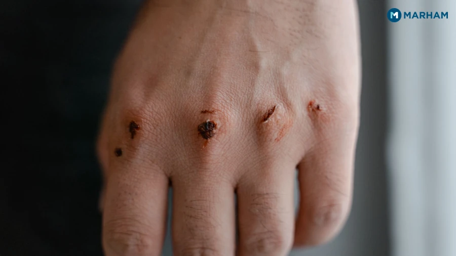 Cuts First Aid: Step-by-Step Wound Care Guide – image 1