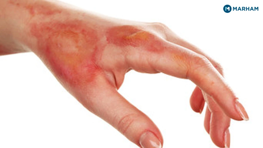 Heat Rash (Gharami)