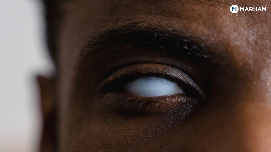 Night Blindness: Causes, Symptoms and Treatment in Pakistan – image 1