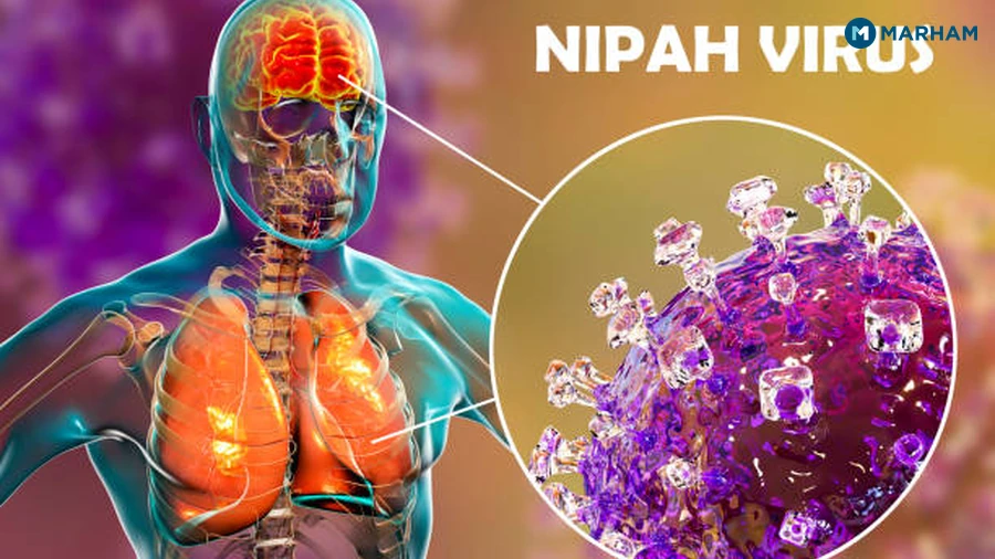 What Is Nipah Virus and Why Is It Considered Serious?