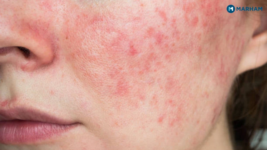 Combination Skin: The Most Common Type in Pakistan