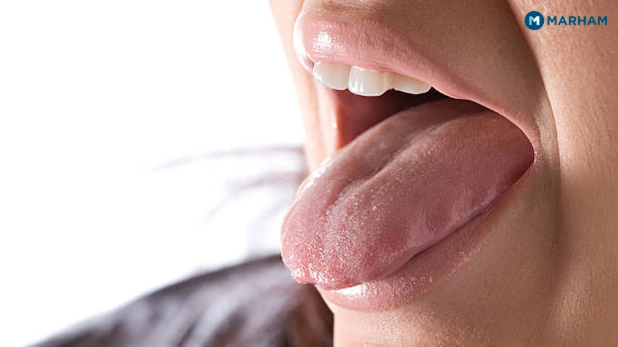 What Is White Tongue?