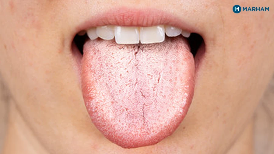 3. Oral Thrush (Candida Overgrowth)
