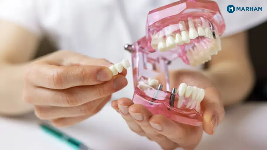 What Are Dental Implants?