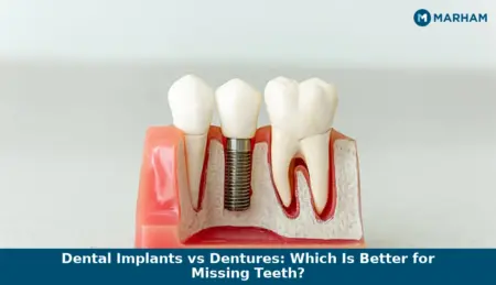 Dental Implants vs Dentures: Which Is Better for Missing Teeth?