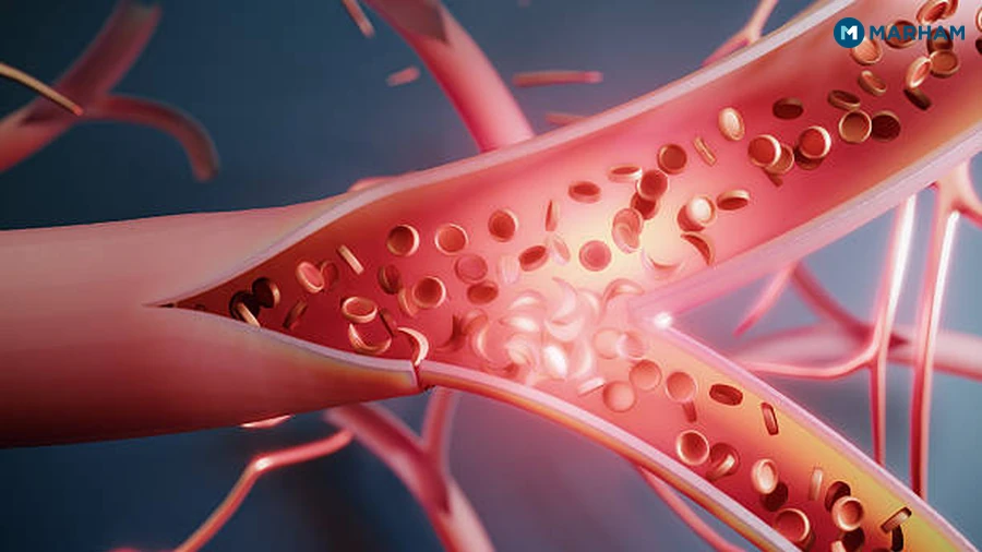 Hemoglobin in Pregnancy: A Special Case