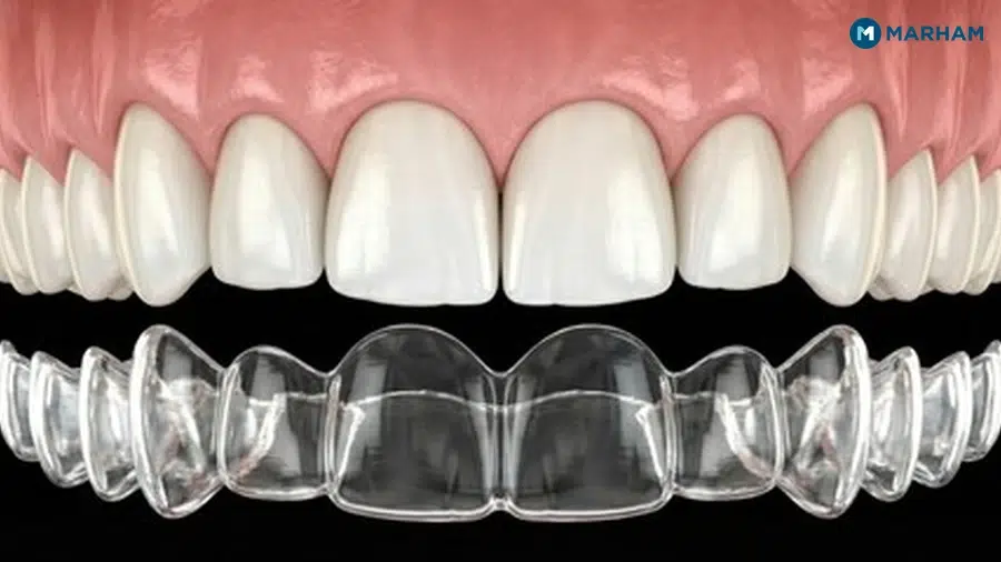Are Clear Aligners as Effective as Braces?