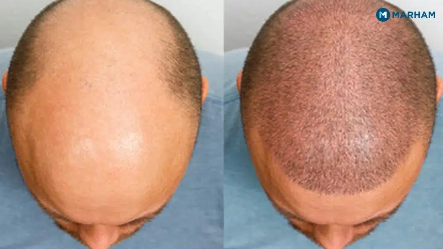 PRP or Hair Transplant: Which One Do You Actually Need?