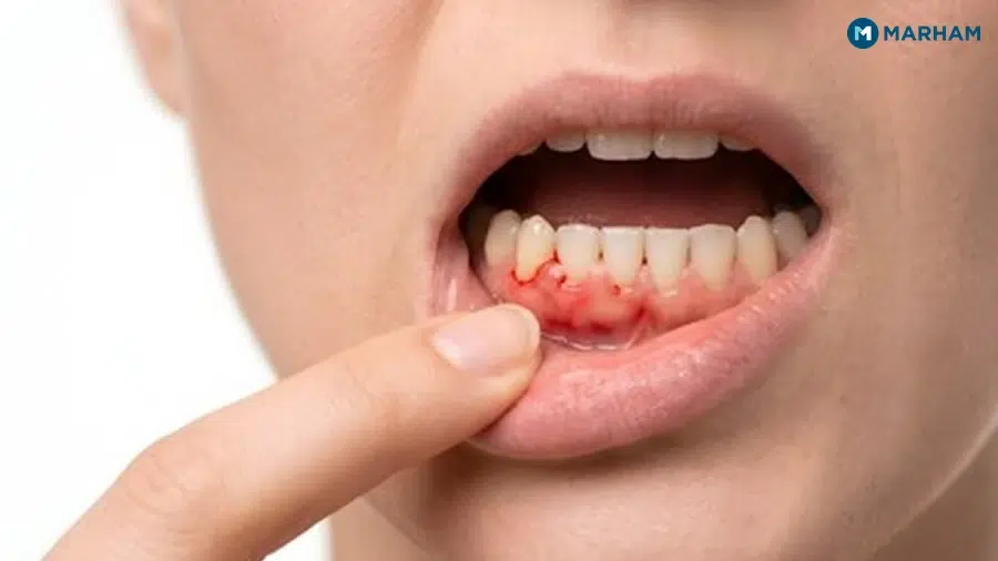 How to Stop Bleeding Gums at Home