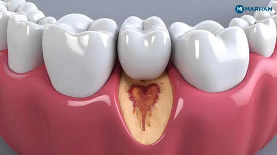 مسوڑھوں سے خون کیوں آتا ہے؟